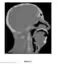 Fig. 09 - Thermoplastic 3-D phantom