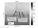 Fig. 03 - Shadow suppression in ultrasound imaging
