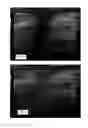 Fig. 06 - Shadow suppression in ultrasound imaging