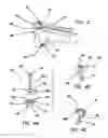 Fig. 03 - Implant devices and systems for stabilized fixation of bone and soft tissue