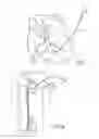 Fig. 19 - Cardiac implant migration inhibiting systems