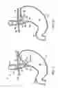 Fig. 02 - Apparatus and method for manipulating stomach tissue and treating gastroesophageal reflux disease