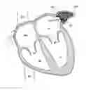 Fig. 01 - LEFT ATRIAL APPENDAGE OCCLUSION DEVICES AND METHODS
