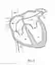Fig. 11 - LEFT ATRIAL APPENDAGE OCCLUSION DEVICES AND METHODS