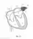 Fig. 13 - LEFT ATRIAL APPENDAGE OCCLUSION DEVICES AND METHODS
