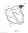 Fig. 14 - LEFT ATRIAL APPENDAGE OCCLUSION DEVICES AND METHODS