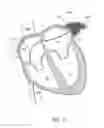 Fig. 15 - LEFT ATRIAL APPENDAGE OCCLUSION DEVICES AND METHODS