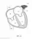 Fig. 17 - LEFT ATRIAL APPENDAGE OCCLUSION DEVICES AND METHODS