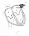 Fig. 18 - LEFT ATRIAL APPENDAGE OCCLUSION DEVICES AND METHODS
