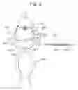 Fig. 09 - Method and apparatus for total knee arthroplasty