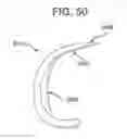 Fig. 41 - Method and apparatus for total knee arthroplasty