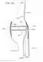 Fig. 47 - Method and apparatus for total knee arthroplasty