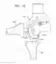 Fig. 72 - Method and apparatus for total knee arthroplasty