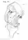 Fig. 74 - Method and apparatus for total knee arthroplasty