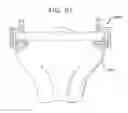 Fig. 75 - Method and apparatus for total knee arthroplasty