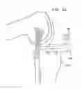 Fig. 76 - Method and apparatus for total knee arthroplasty