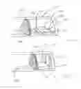 Fig. 06 - Calculus retrieving/removing device and method