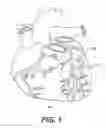 Fig. 02 - Endovascular devices and methods