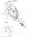 Fig. 07 - SURGICAL STABILIZER AND CLOSURE SYSTEM