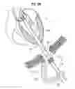 Fig. 11 - SURGICAL STABILIZER AND CLOSURE SYSTEM