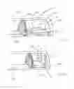 Fig. 06 - Calculus retrieving/removing device and method