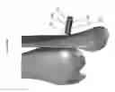 Fig. 100 - Intramedullary fracture fixation devices and methods