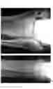 Fig. 34 - Intramedullary fracture fixation devices and methods