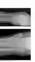 Fig. 35 - Intramedullary fracture fixation devices and methods
