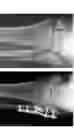 Fig. 38 - Intramedullary fracture fixation devices and methods