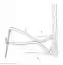 Fig. 53 - Intramedullary fracture fixation devices and methods