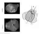 Fig. 70 - Intramedullary fracture fixation devices and methods