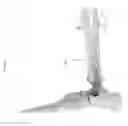 Fig. 71 - Intramedullary fracture fixation devices and methods