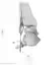 Fig. 77 - Intramedullary fracture fixation devices and methods
