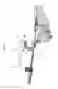 Fig. 78 - Intramedullary fracture fixation devices and methods