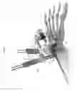 Fig. 84 - Intramedullary fracture fixation devices and methods