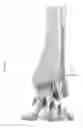 Fig. 88 - Intramedullary fracture fixation devices and methods