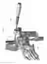 Fig. 99 - Intramedullary fracture fixation devices and methods