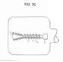 Fig. 07 - Expansion Screw Bone Tamp