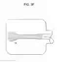 Fig. 10 - Expansion Screw Bone Tamp