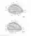 Fig. 04 - Textile-based prosthesis for treatment of inguinal hernia