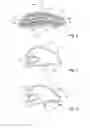 Fig. 05 - Textile-based prosthesis for treatment of inguinal hernia