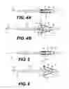 Fig. 04 - TEMPORARY EMBOLIC PROTECTION DEVICE AND METHODS THEREOF