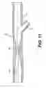 Fig. 08 - TEMPORARY EMBOLIC PROTECTION DEVICE AND METHODS THEREOF