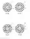 Fig. 05 - Ureteral stents with waveform interlayers and interstitching