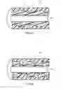 Fig. 06 - Ureteral stents with waveform interlayers and interstitching