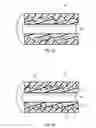 Fig. 07 - Ureteral stents with waveform interlayers and interstitching