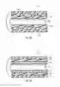 Fig. 08 - Ureteral stents with waveform interlayers and interstitching