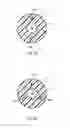 Fig. 09 - Ureteral stents with waveform interlayers and interstitching