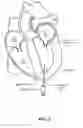 Fig. 03 - Trans-apical implant systems, implants and methods