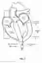Fig. 04 - Trans-apical implant systems, implants and methods